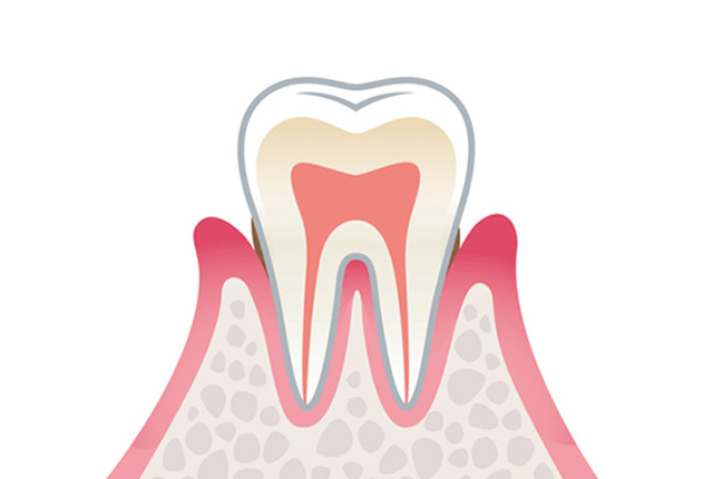 軽度歯周病